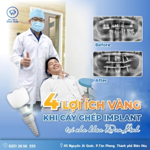 4-loi-ich-khi-trong-rang-impalnt
