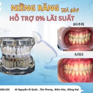 nieng-rang-tra-gop-tai-bien-hoa-uu-dai-lon-cho-hoc-sinh-sinh-vien-tai-nha-khoa-dan-anh