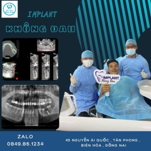 cay-ghep-implant-giai-phap-khoi-phuc-rang-mat-toan-dien-tai-bien-hoa