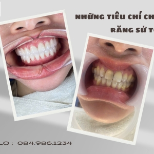 nhung-tieu-chi-lua-chon-dia-chi-boc-rang-su-tot-nha-khoa-dan-anh-bien-hoa