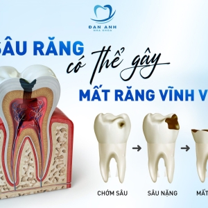 sau-rang-va-cach-khac-phuc-hieu-qua-tai-nha-khoa-dan-anh-bien-hoa