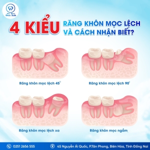 cac-dang-rang-khon-moc-lech-nguy-hiem